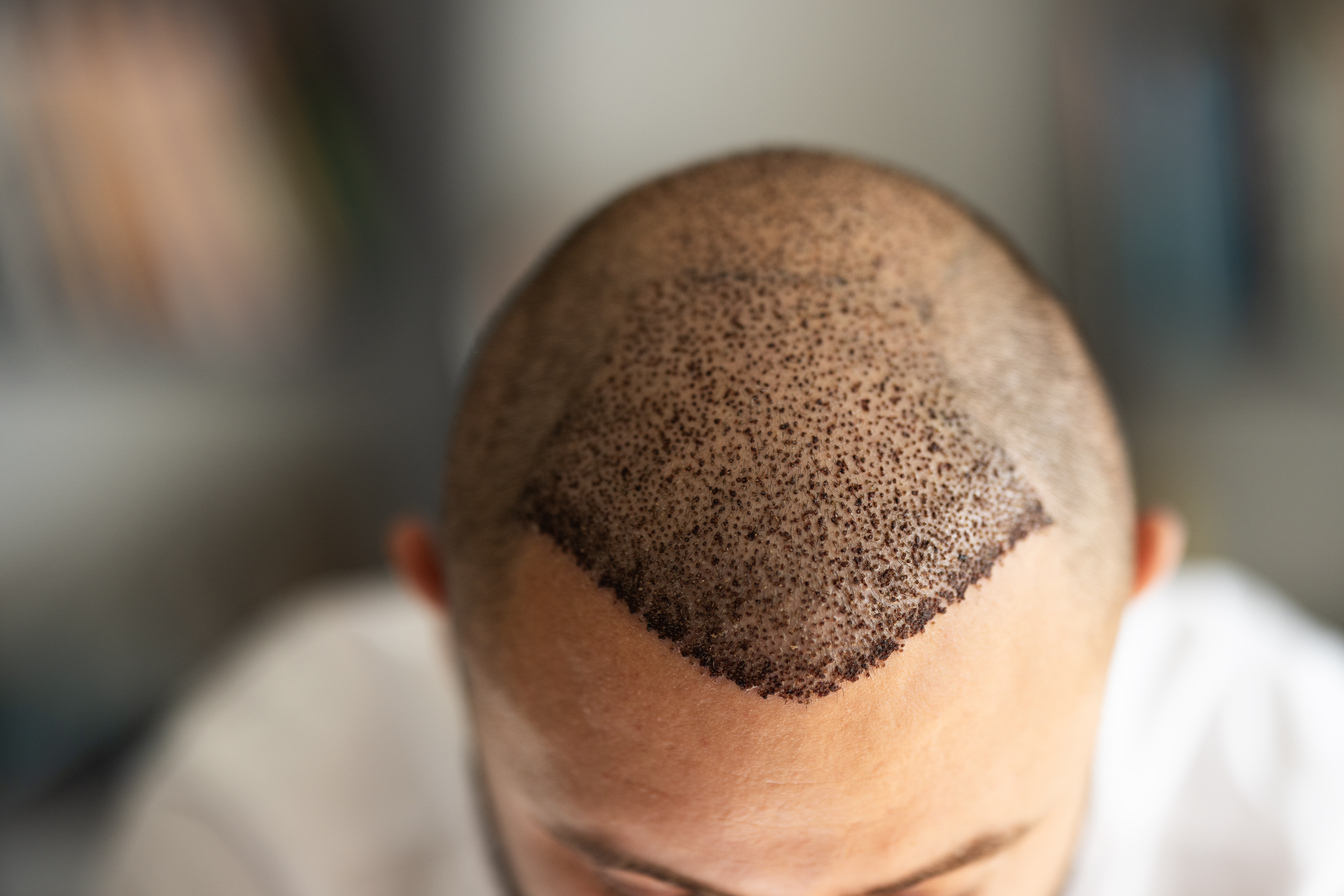 Hair Restoration at PrimeTime Mens Clinic